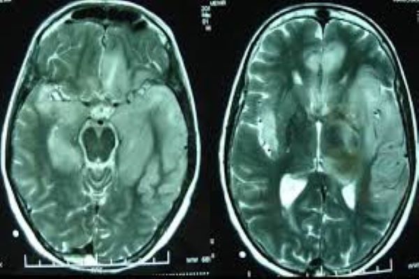 Chụp CT não có ảnh hưởng gì không? Chụp cắt lớp não có nguy hiểm?